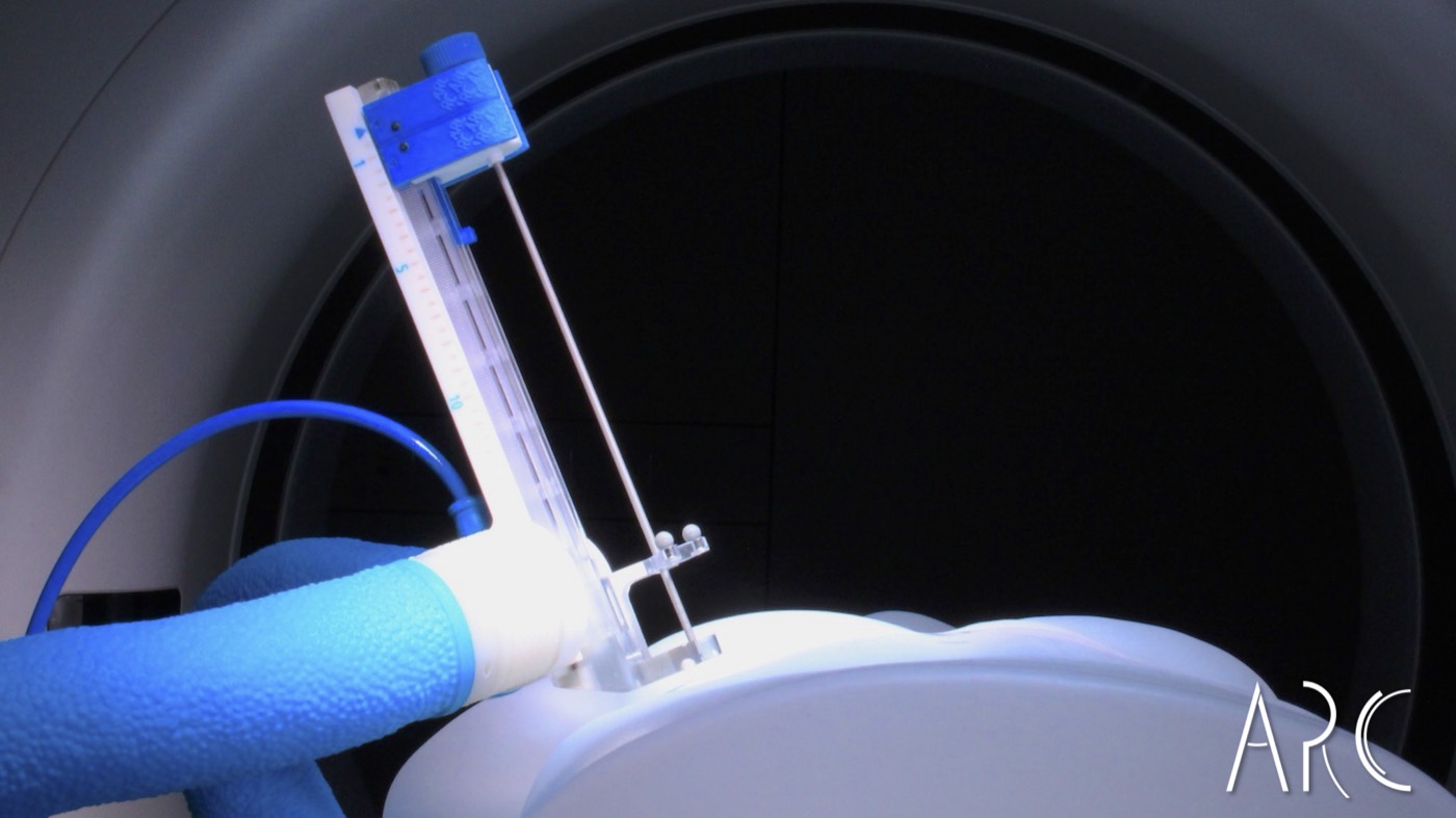 ARC needle clinical context