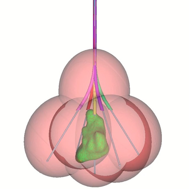 Thermal ablation example